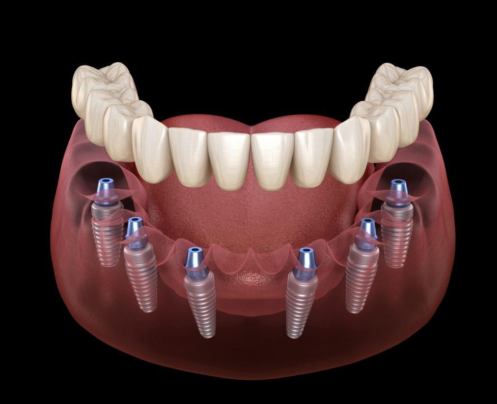 all on 6 dental implants